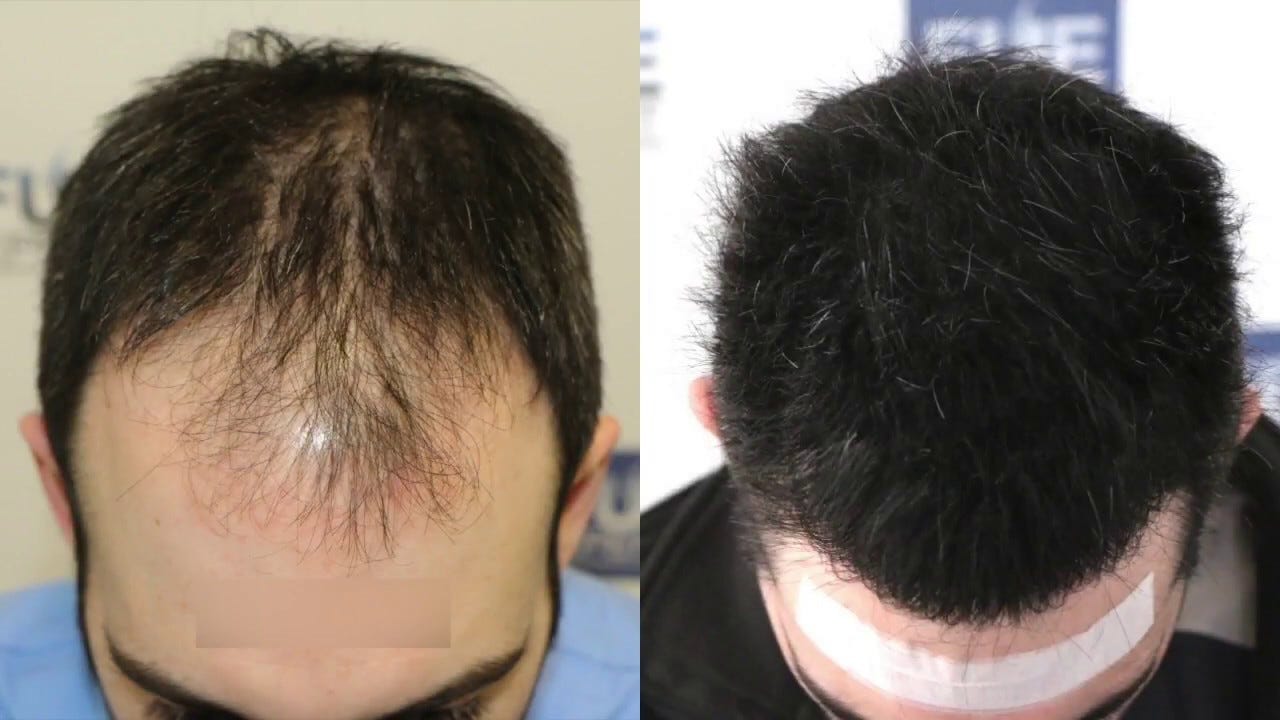 Hair Transplant For The Treatment Of Hair Loss From Hair Clinic