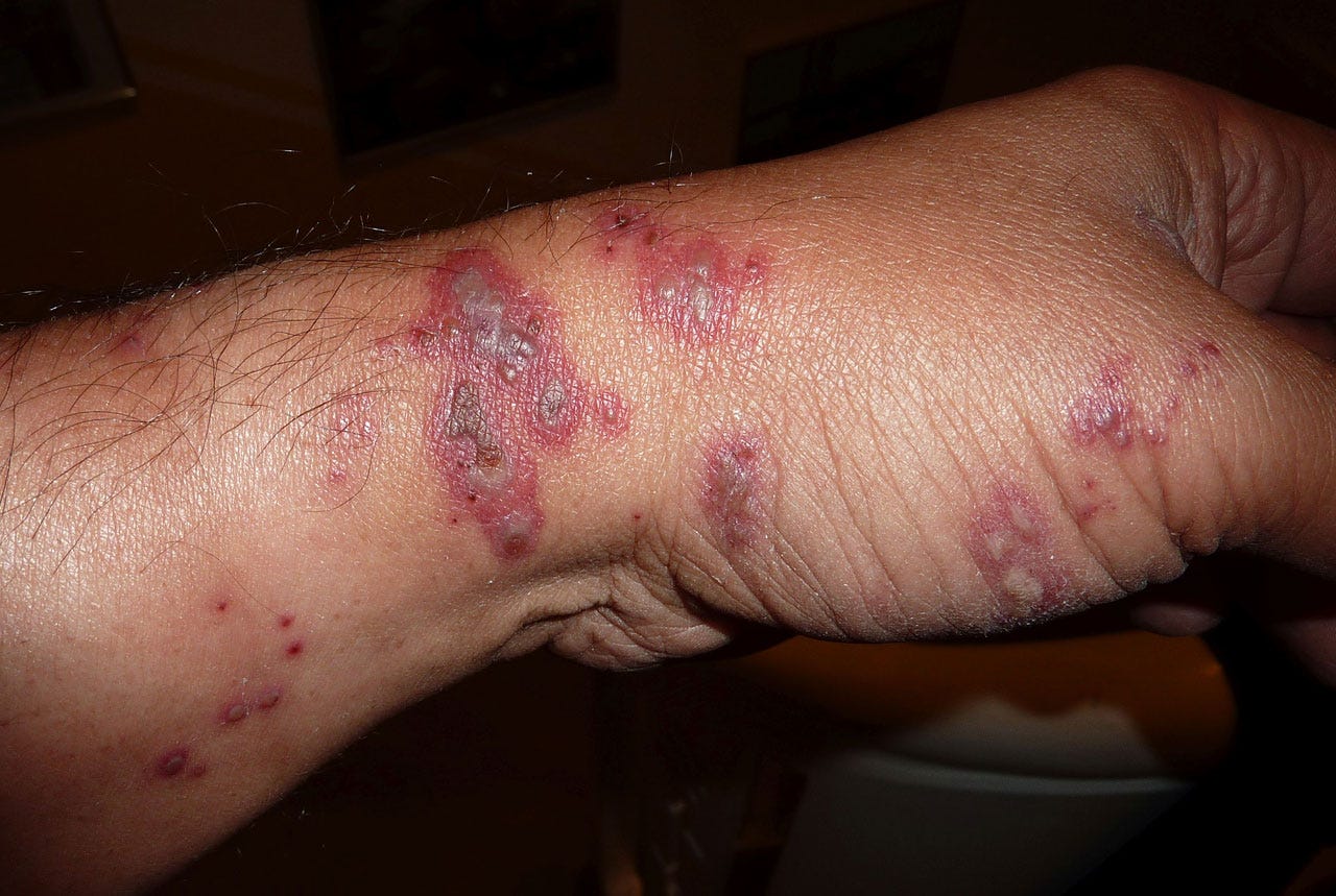 How I Survived The Bubonic Plague Sort Of The Friedel