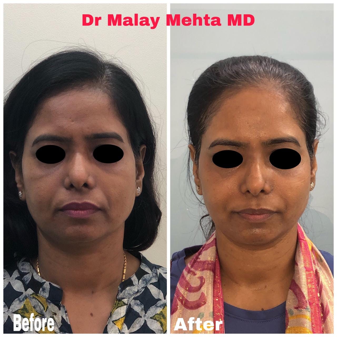 Malar Festoon And Smile Lines Dr Malay Mehta Medium