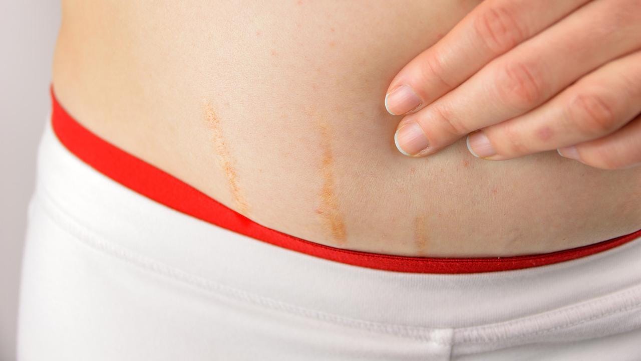 Strecth Marks Kenapa Bisa Muncul By Upmedik Your Place To Discover Wellness Medium