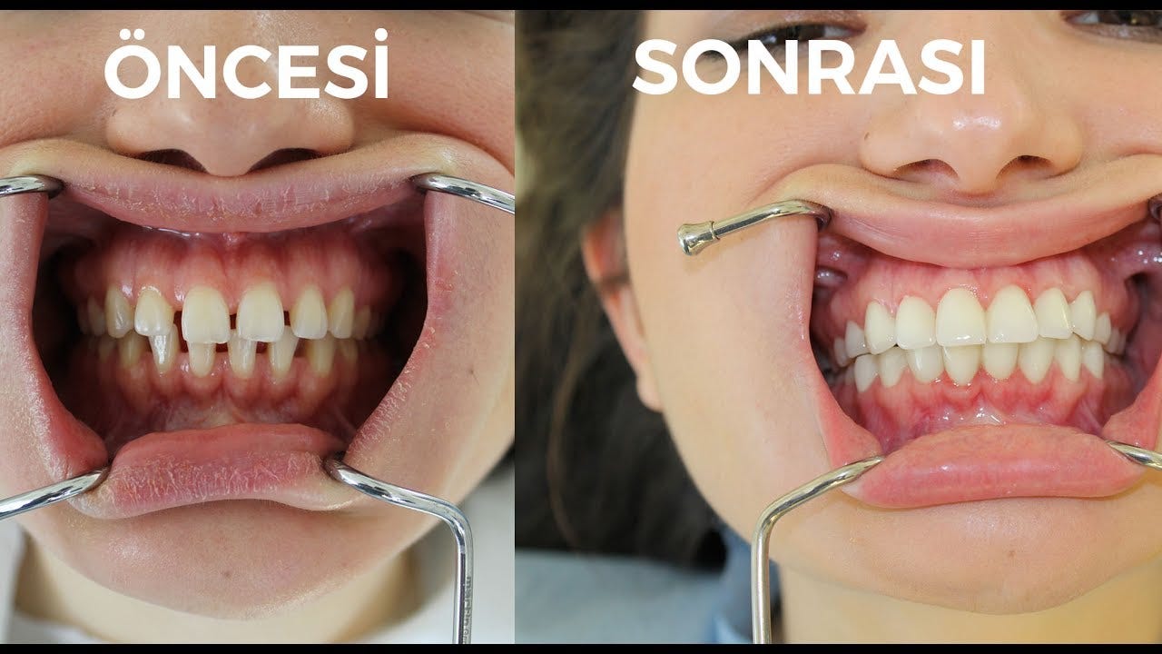 Zirkonyum Dis Tedavisi Nedir Nasil Yapilir By Dr Dt Sadik Gencoglan Medium