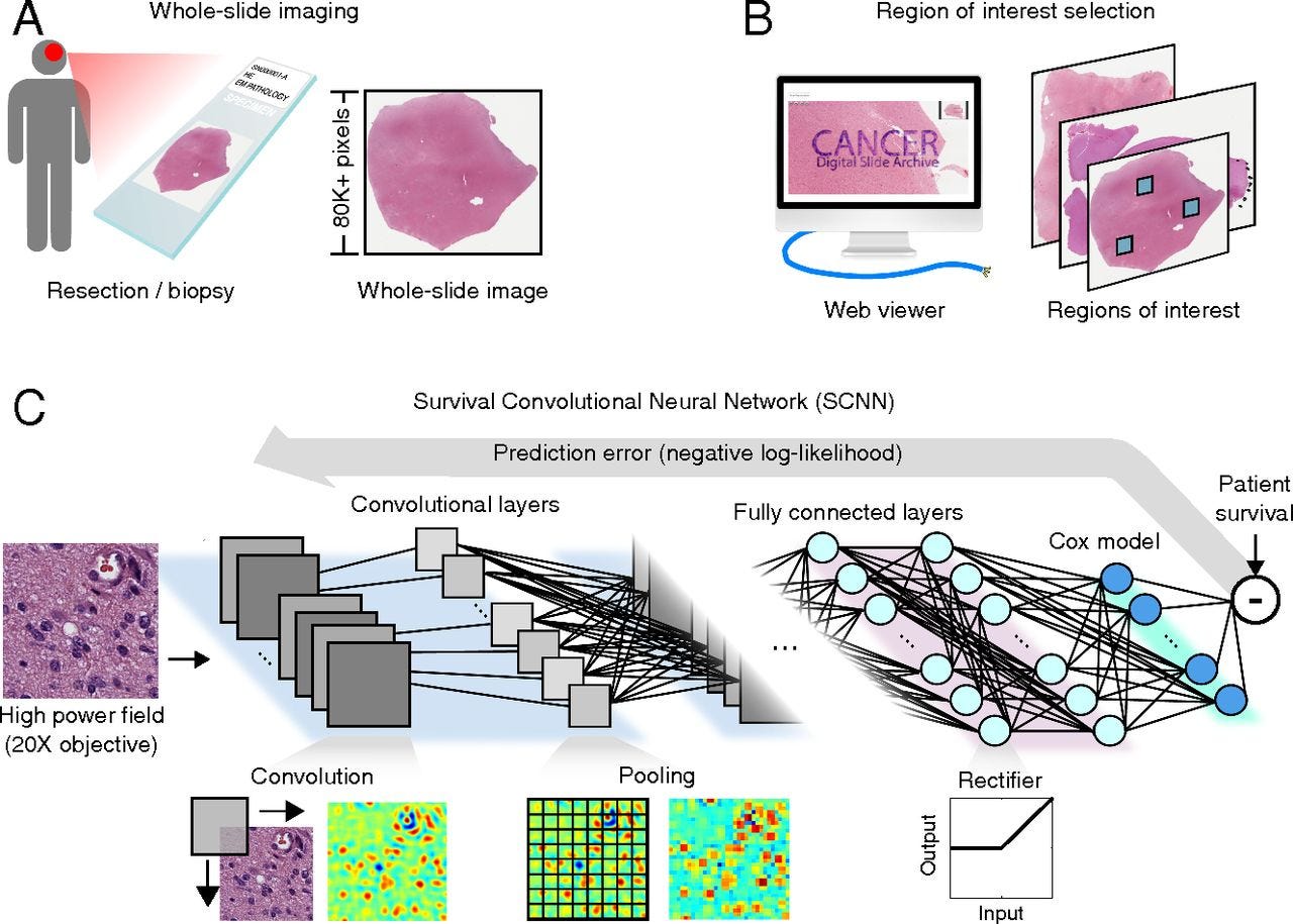 News AI turned to be better than Pathologists in Predicting Survival