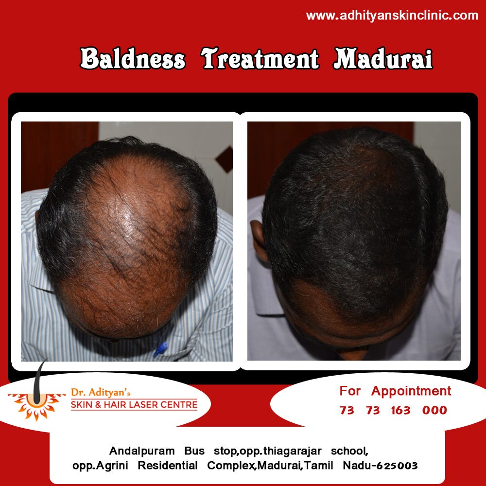 Male Hair Loss Are You Need Treatment Contact Adityan Ms