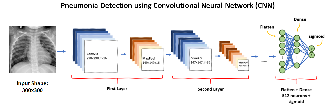 Chest X Rays Pneumonia Detection Using Convolutional Neural Network By Christie Natashia Archie Towards Data Science