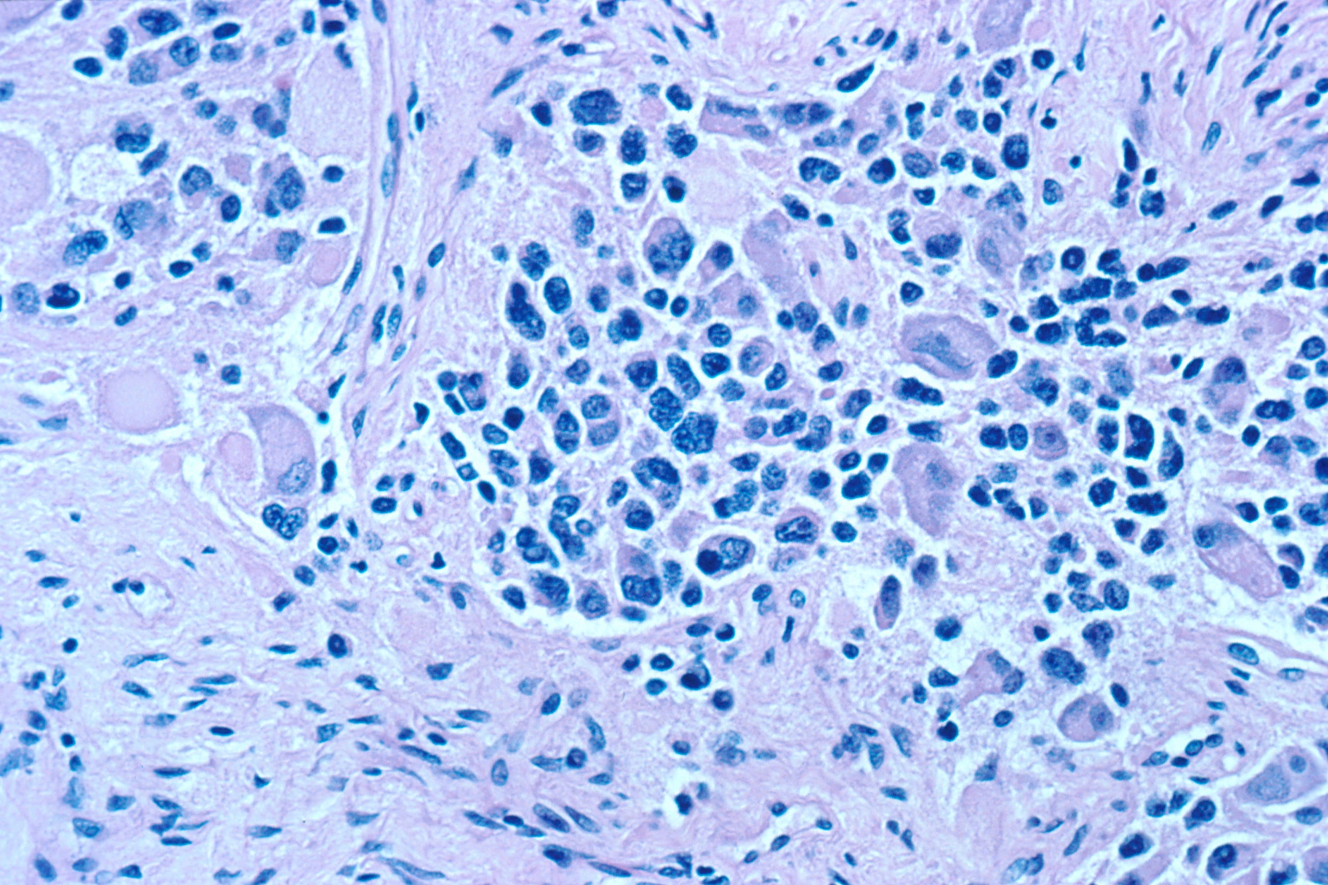 Neuroblastoma: a cancer model for IMPRES
