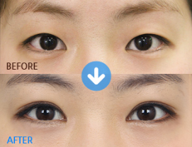 single eyelid double eyelid