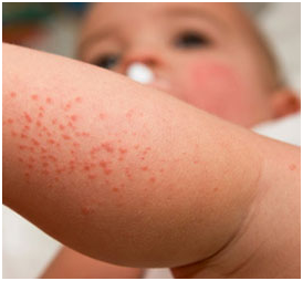 What Causes Atopic Dermatitis In Children By Roshan Jamal Medium