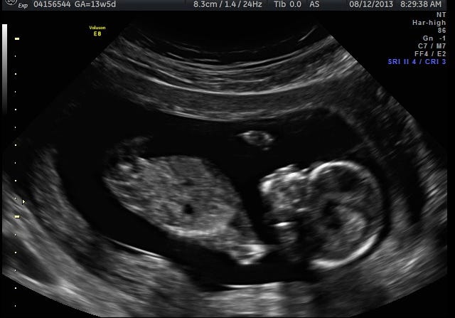 Nuchal scan results