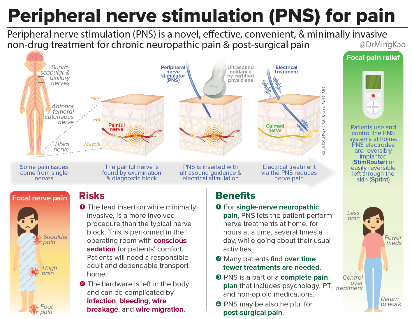 Peripheral nerve stimulation (PNS) for chronic pain & postsurgical