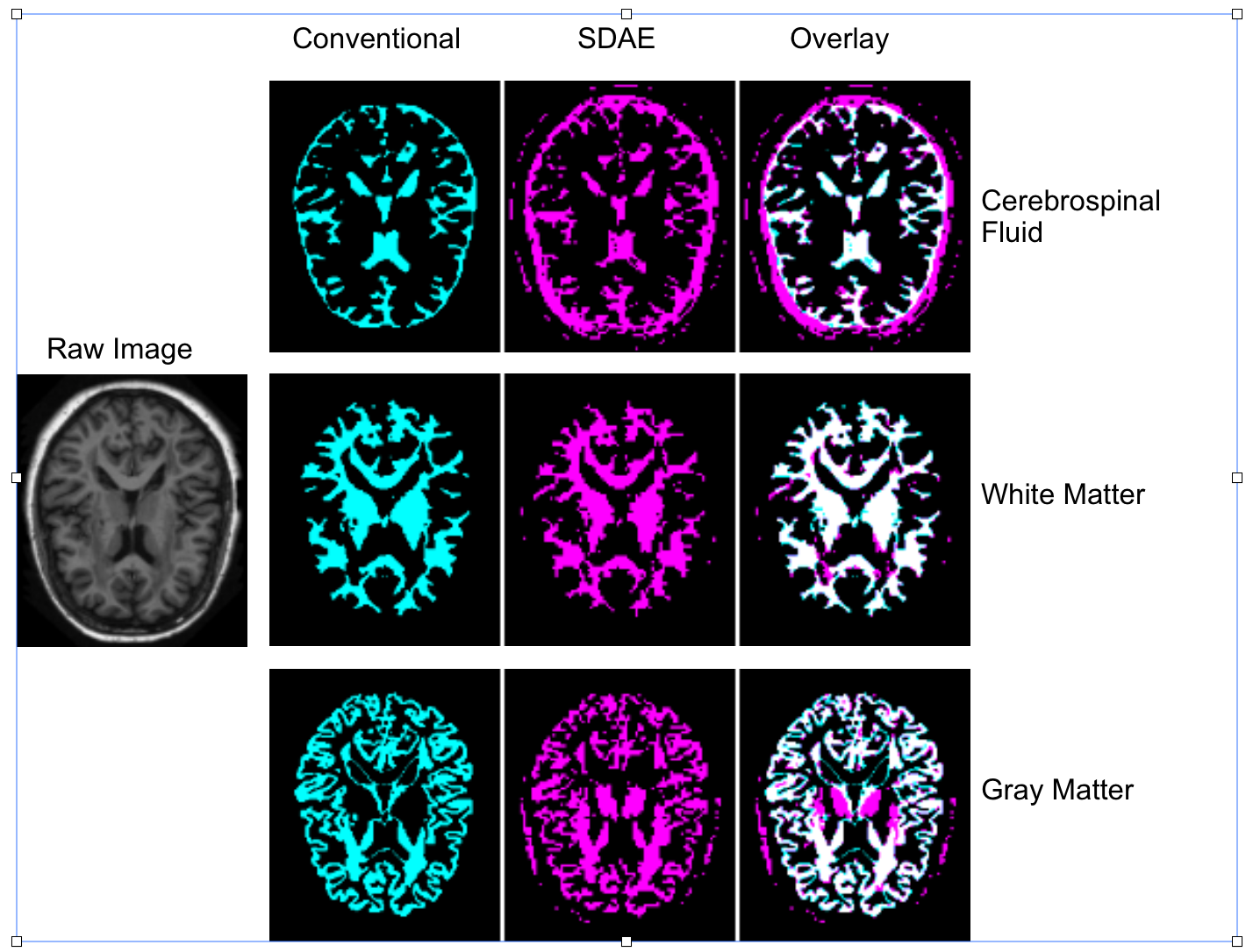 Brain MRI image segmentation using Stacked Denoising Autoencoders by