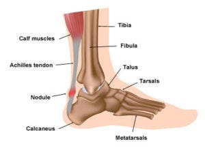 foot pain achilles tendon area