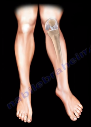 Valgus Knee Deformity. When The Knee Is Not Perfectly Aligned… | By Nabil  Ebraheim | Medium
