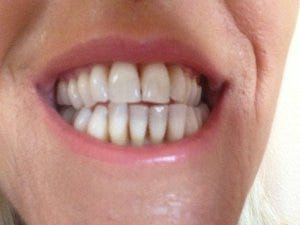 Can You Reverse Receding Gums Without Surgery? | by How To Reverse Receding  Gums without Surgery | Medium