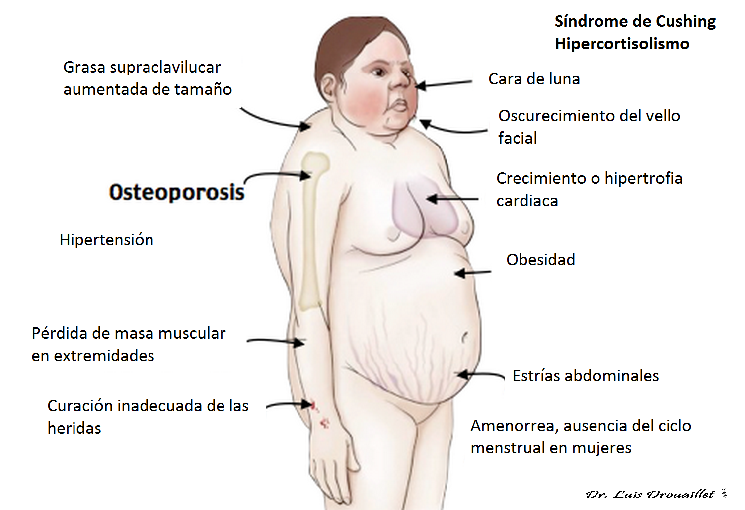 Conheça a Síndrome de Cushing o que é, causas, sintomas e tratamento. Conhecer para Prevenir Conheça a Síndrome de Cushing o que é, causas, sintomas e tratamento. Conhecer para Prevenir