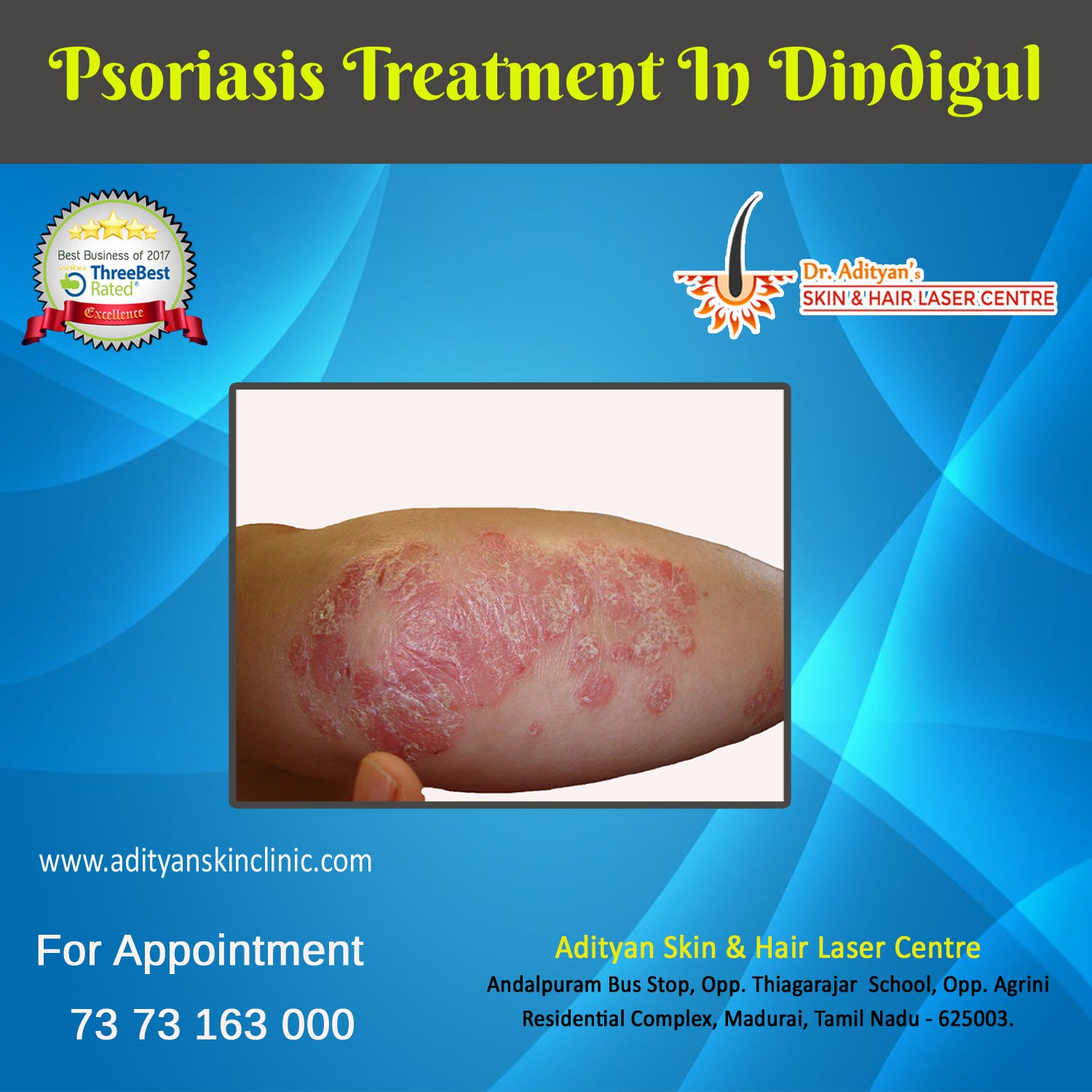 psoriasis treatment in tamil