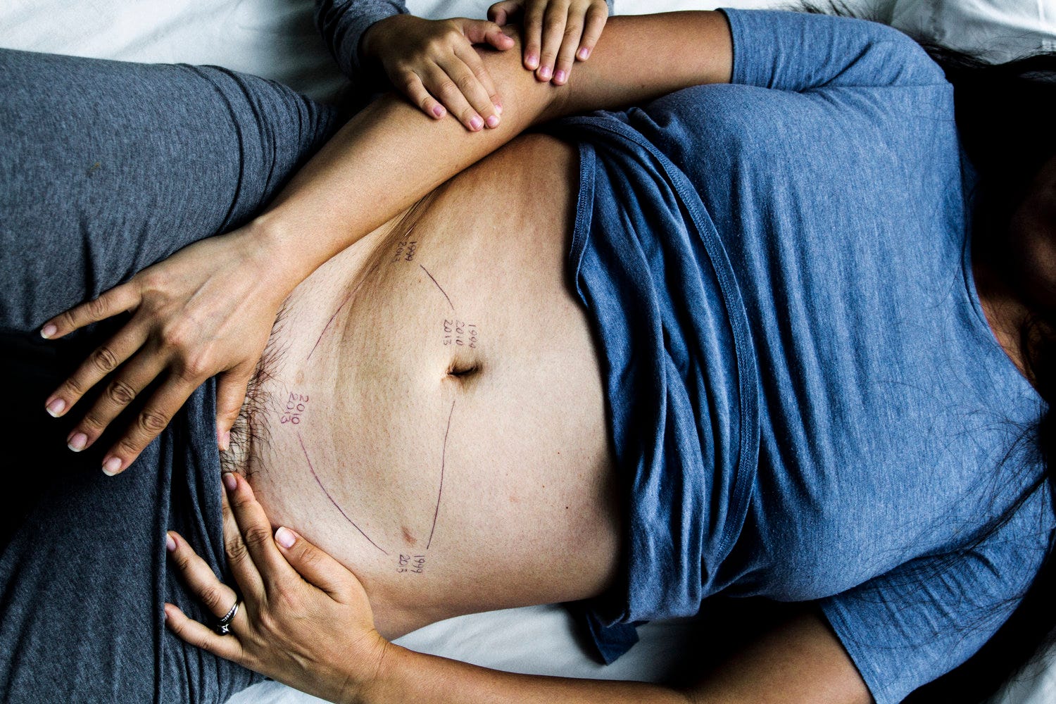 Essa Ã© minha barriga de endometriose | by Karol Gomes