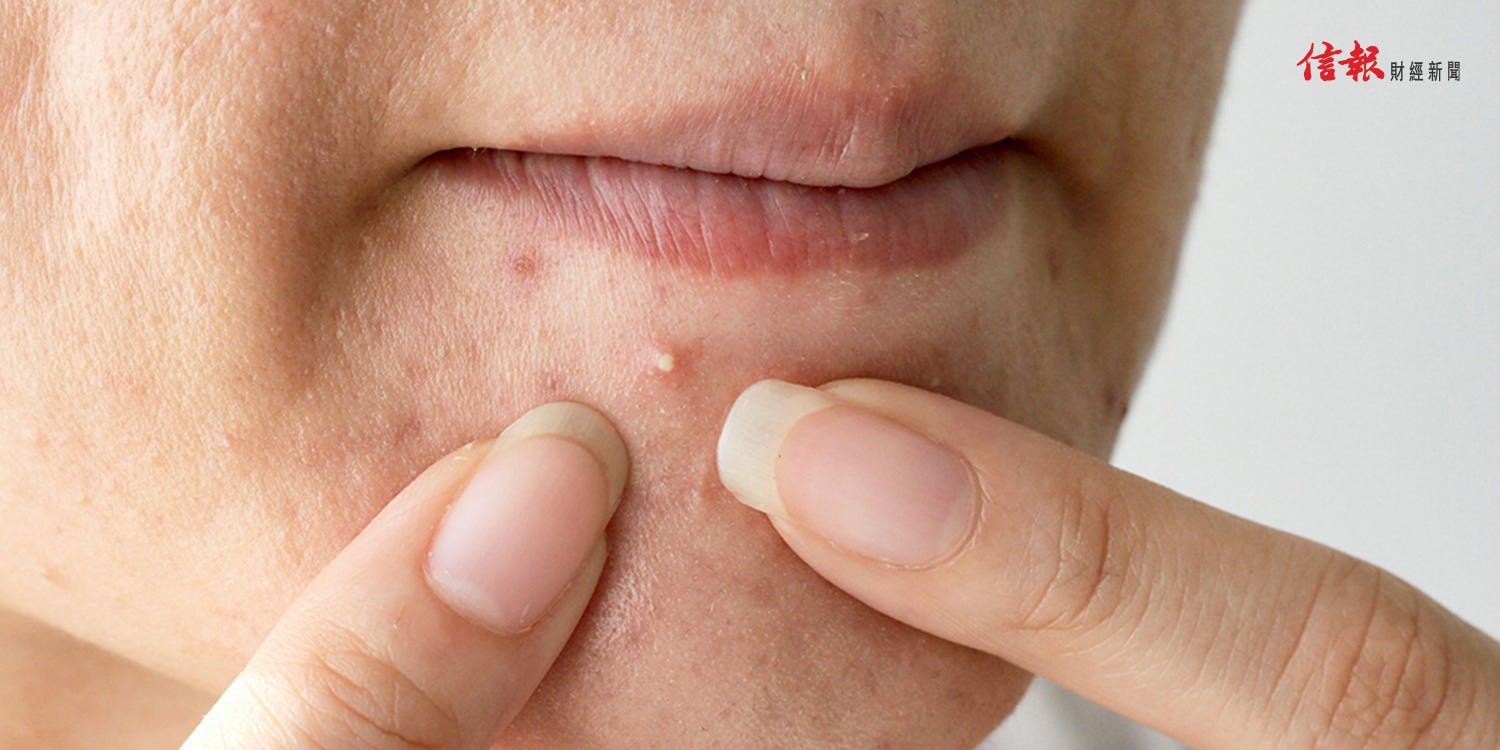 面部油脂粒不容忽視 醫言美麗 楊明霞中醫師 By 信報財經新聞 信報財經新聞hkej Medium