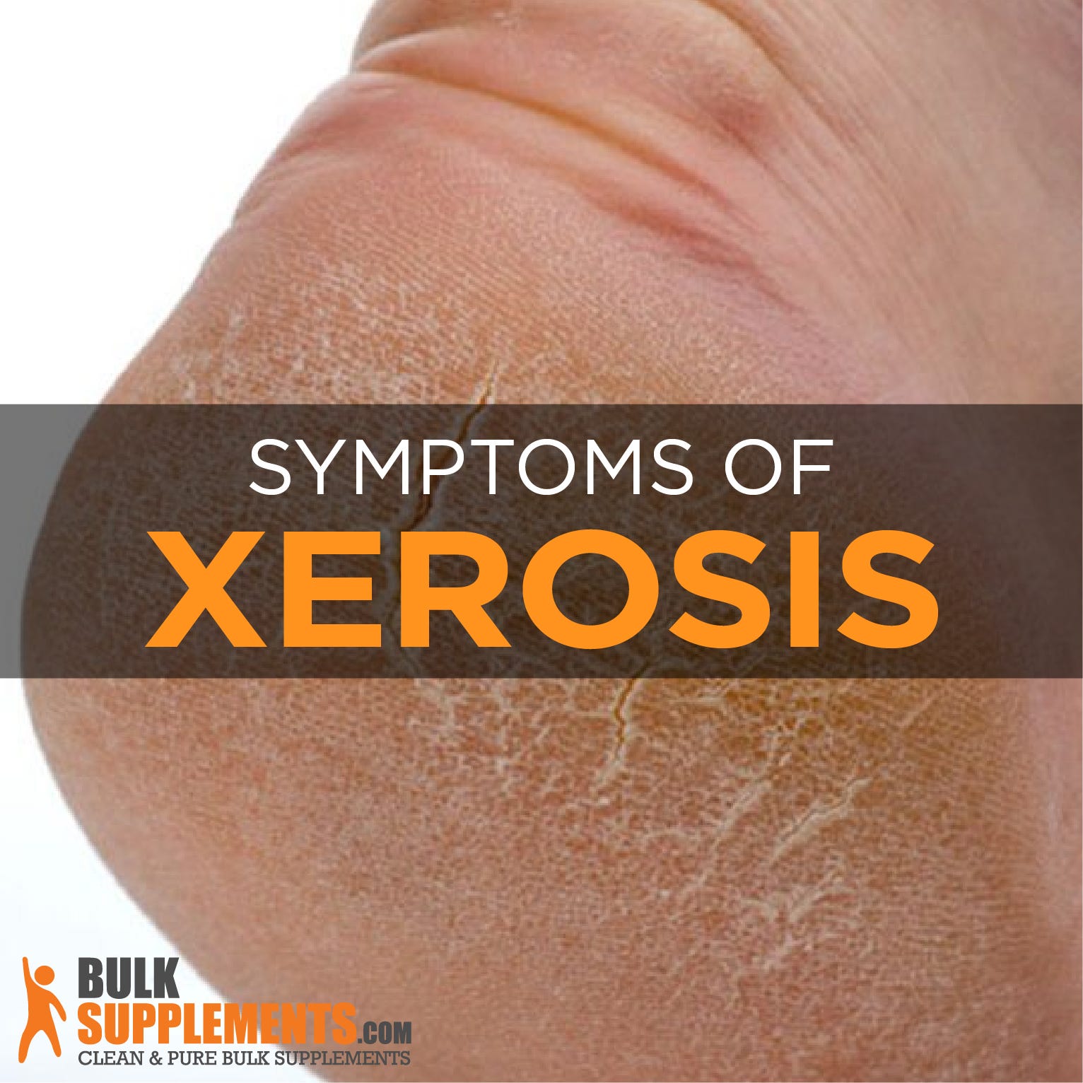 Xerosis Dry Skin Symptoms Causes And Treatment By James Denlinger