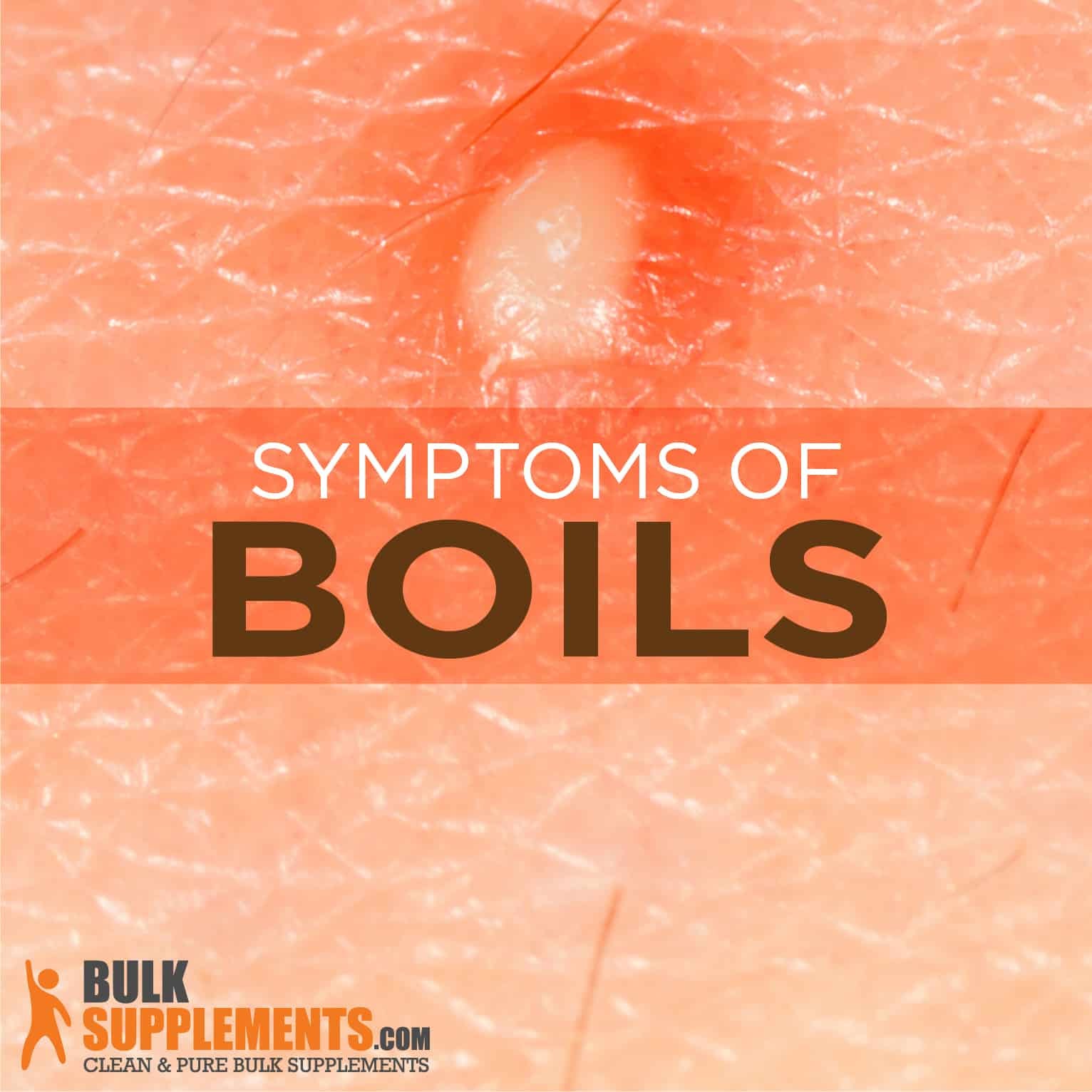 Boils Symptoms, Causes and Treatment by James