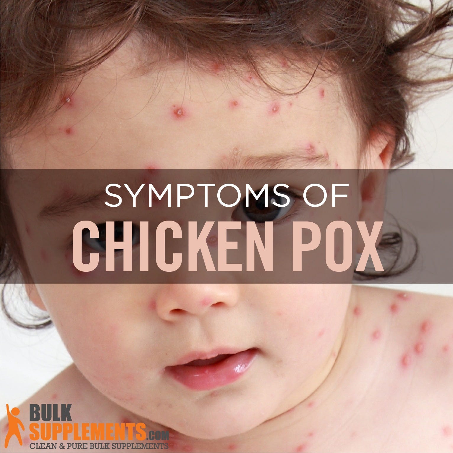 Varicella (Chickenpox) Causes, Symptoms & Treatment by James