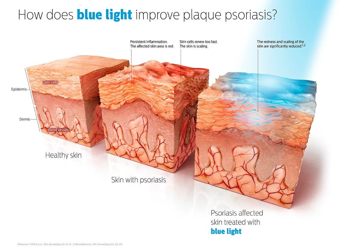 light therapy for eczema