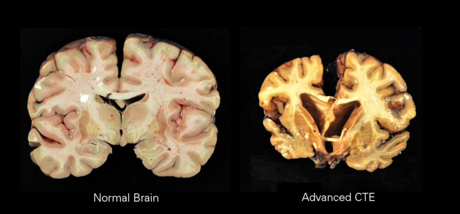 Chronic Traumatic Encephalopathy prominence in former NFL Players by Sam Hooker Medium