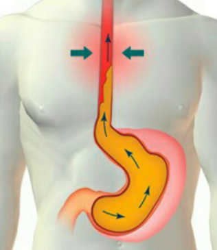 Ciri Ciri Gejala Penyakit Asam Lambung - Ini Cirinya