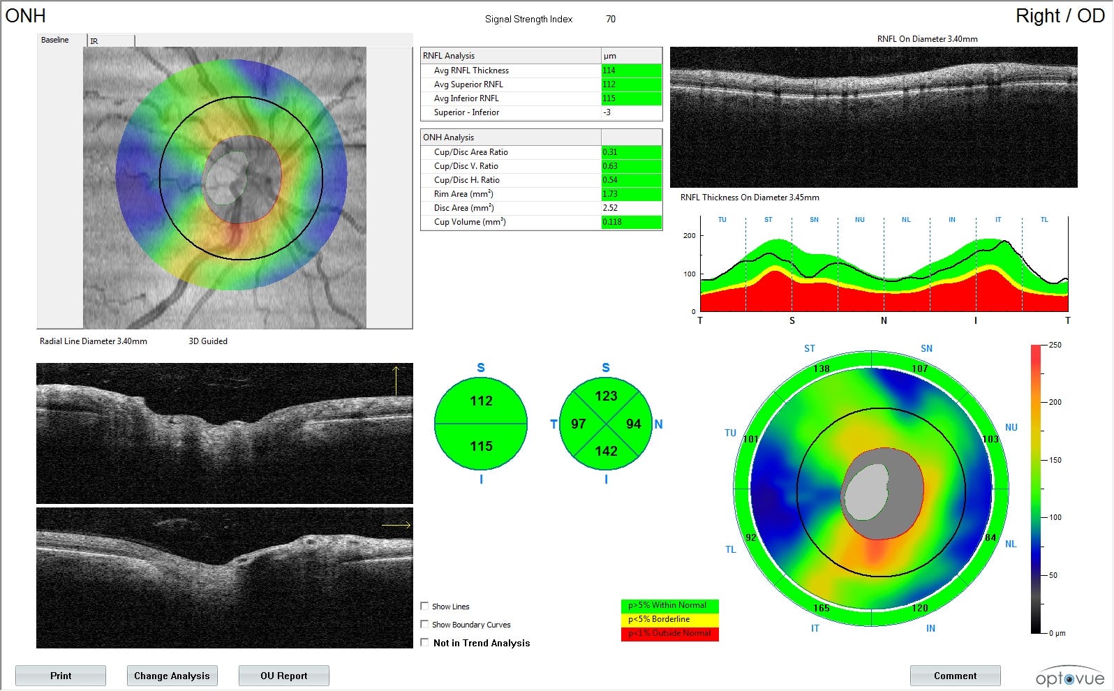 Очни прояви при заболявания на щитовидната жлеза | by Atanas Bogoev M.D. |  Очно Здраве