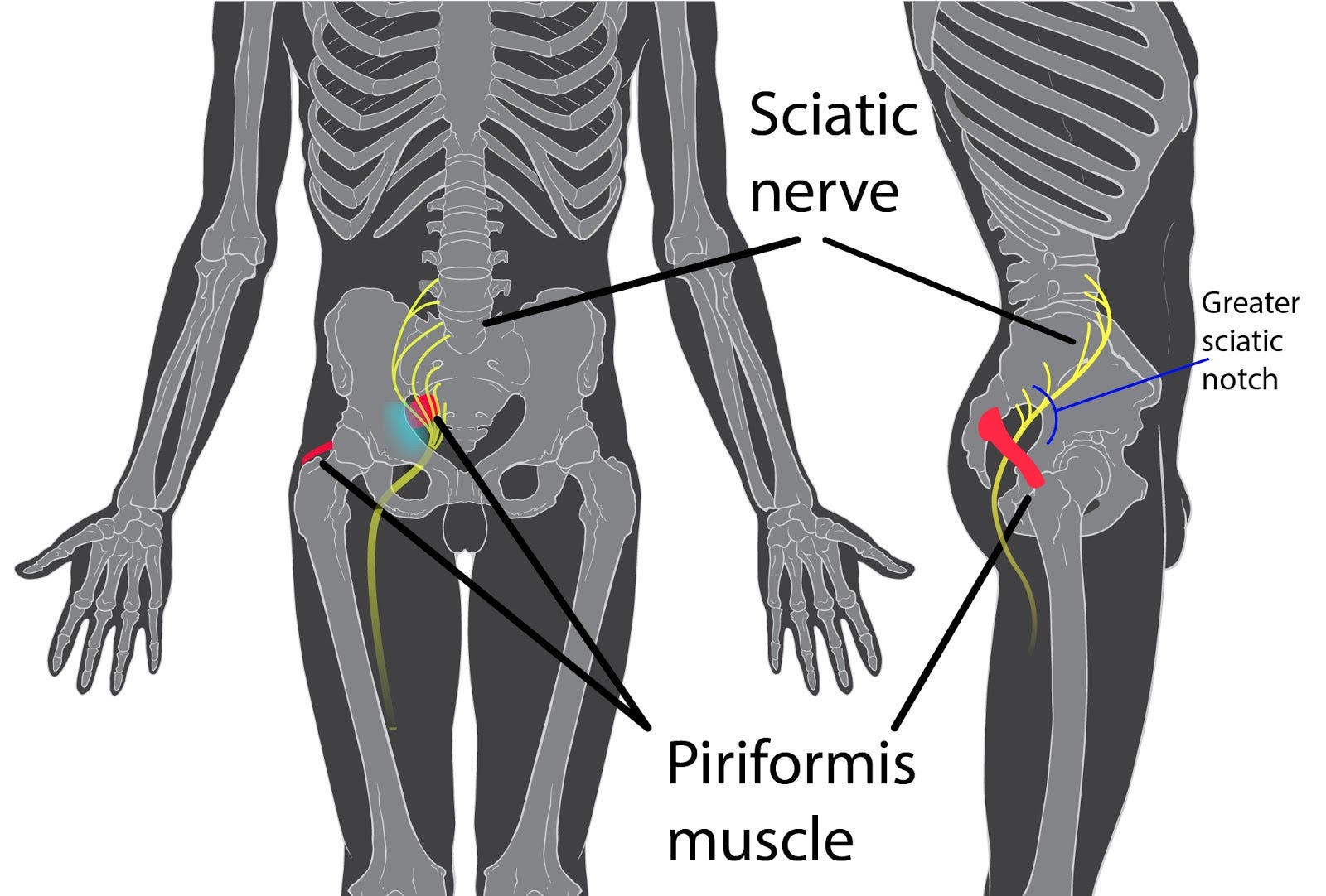 When Is Sciatica Not Sciatica By Dr Steven Zodkoy By Dr Steven Zodkoy D C C N S D A C B N Medium