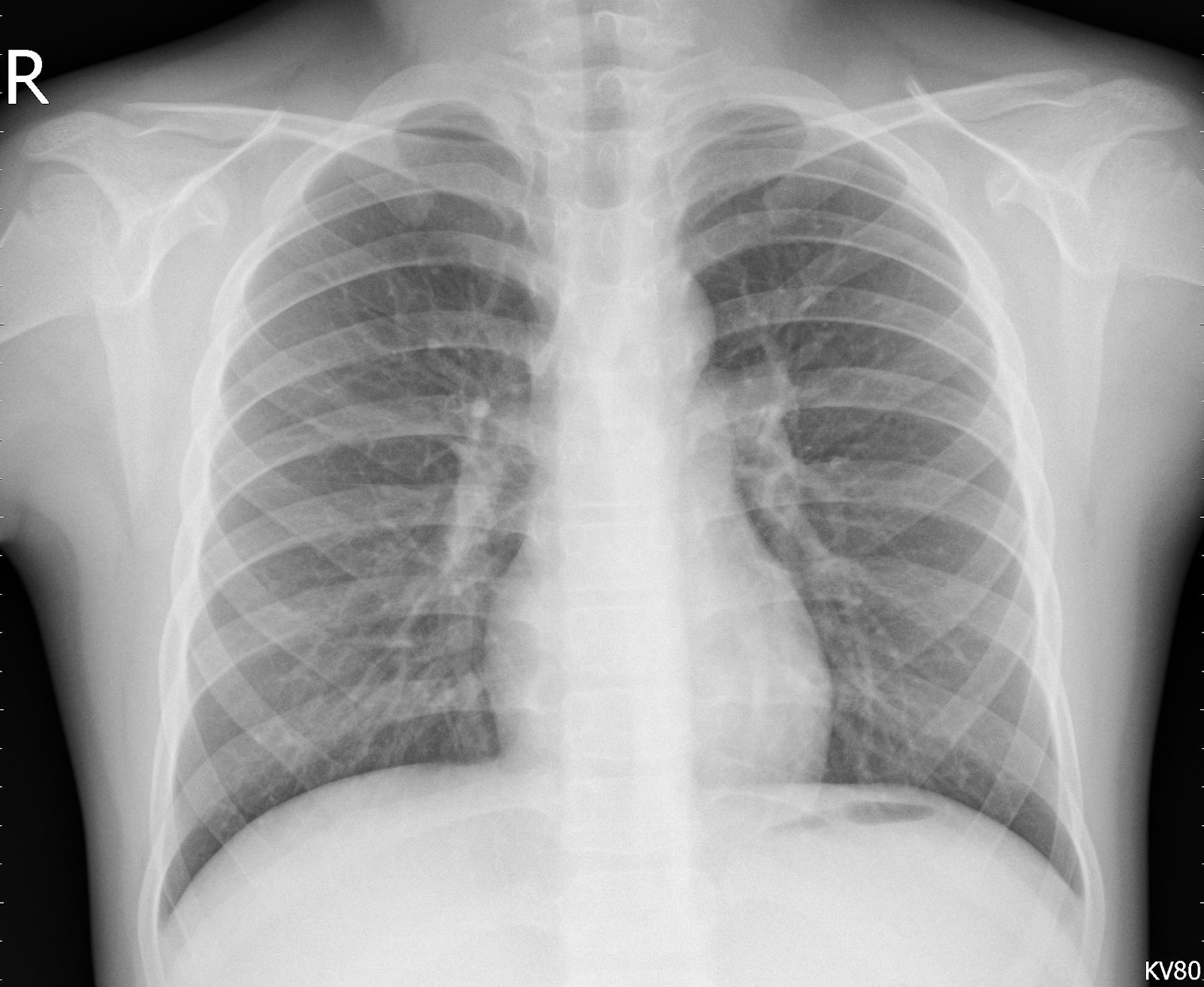 detecting-pneumonia-on-x-ray-images-convnets-and-transfer-learning