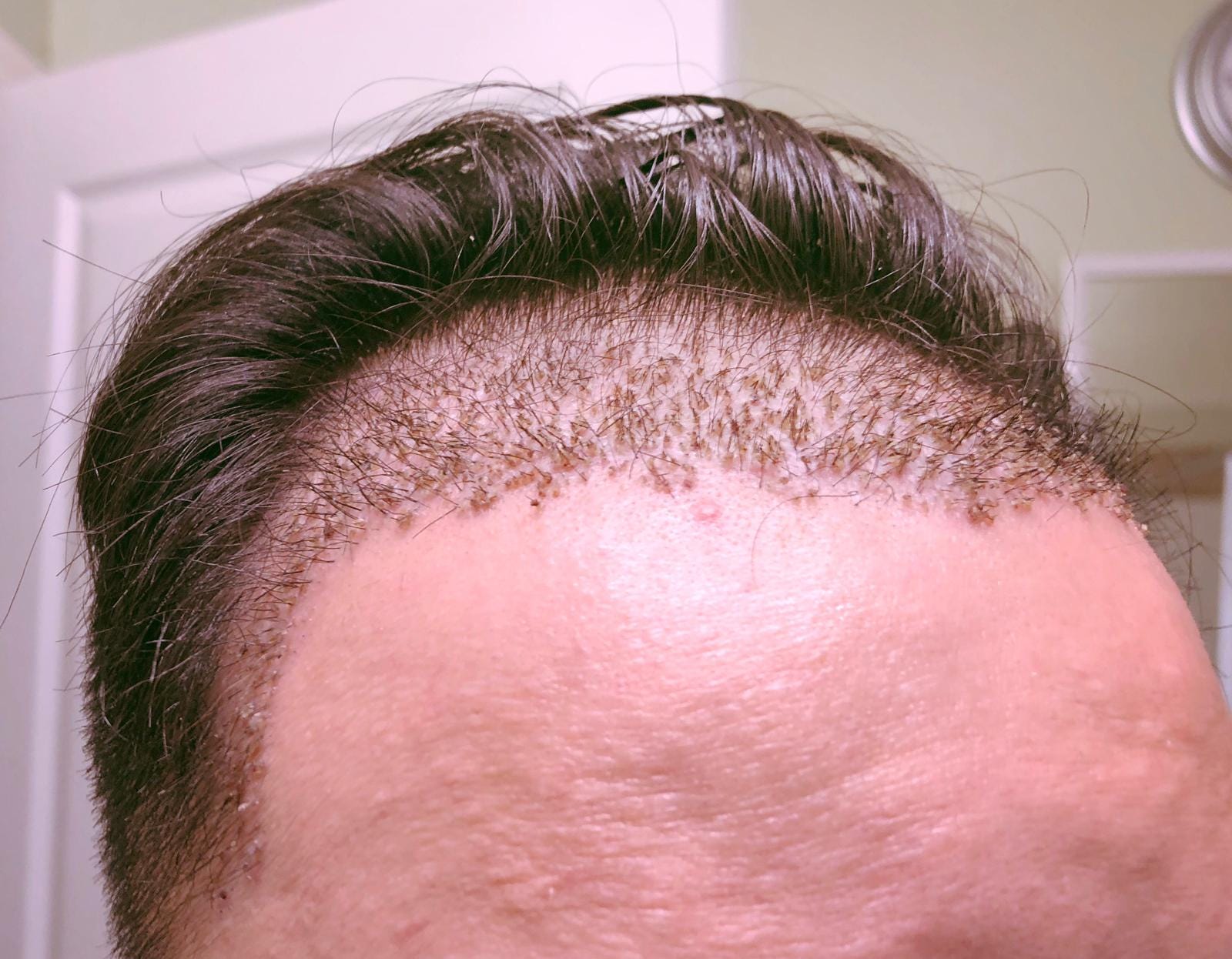 Days 14–16 (Week 2 post-op). I haven't been posting much, but I have… | by  My Hair Restoration Story | Medium