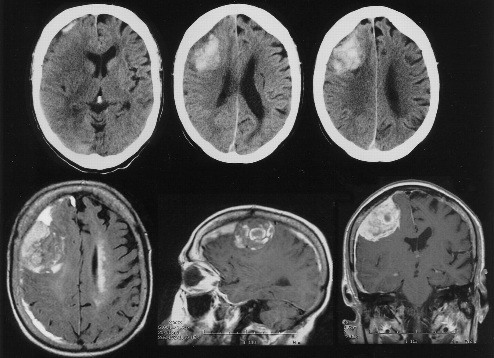 Brain Haemorrhage Segmentation From Ct Scan Images Us - vrogue.co