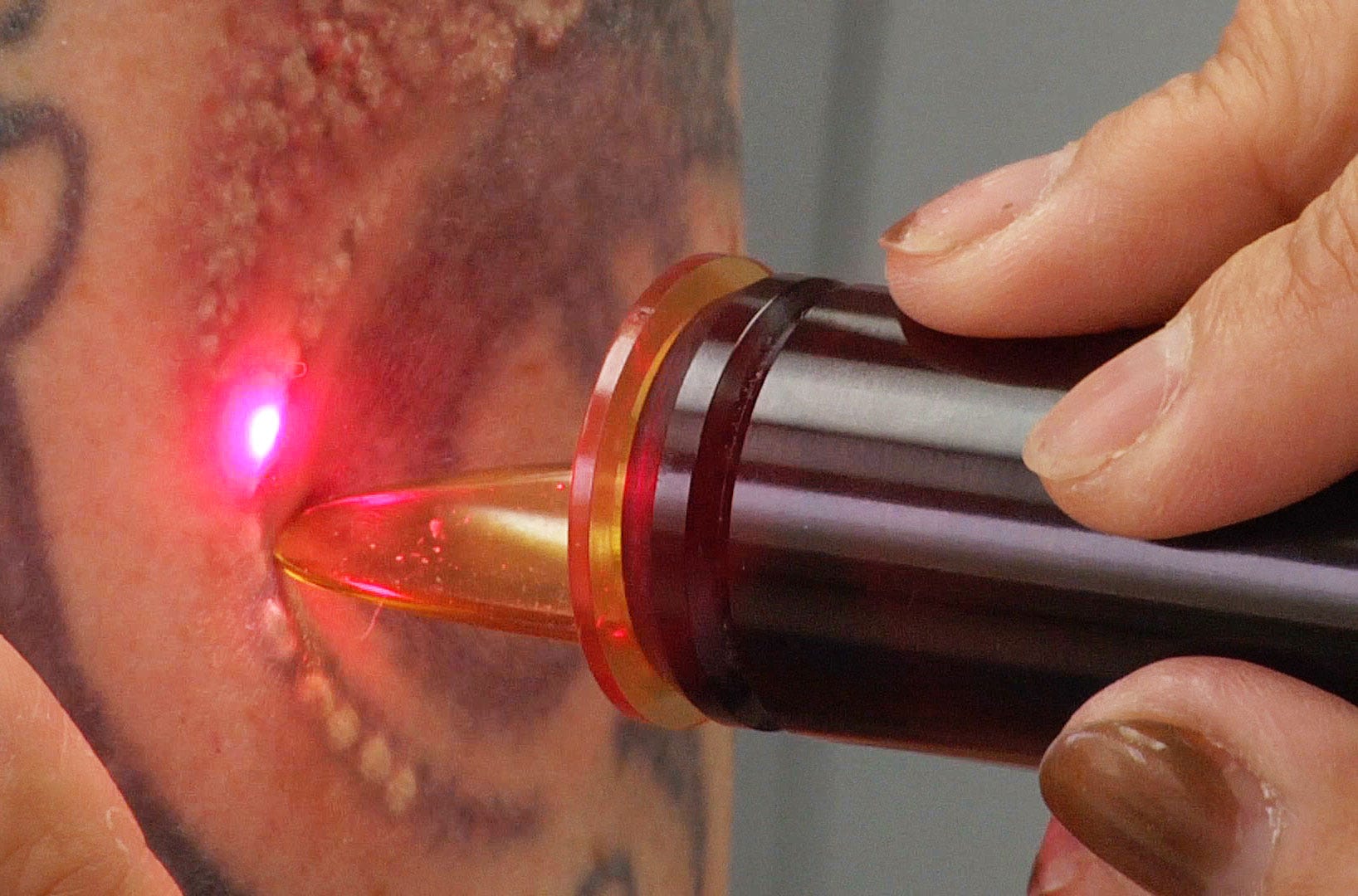 Laser Tattoo Removal Treatment Thinning Hair Treatment