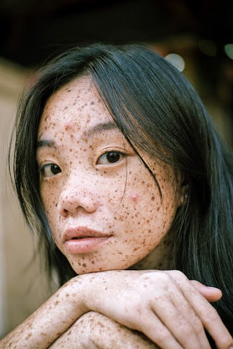 How To Get Rid Of Pus Pimples Naturally By Hansidhankhar Medium