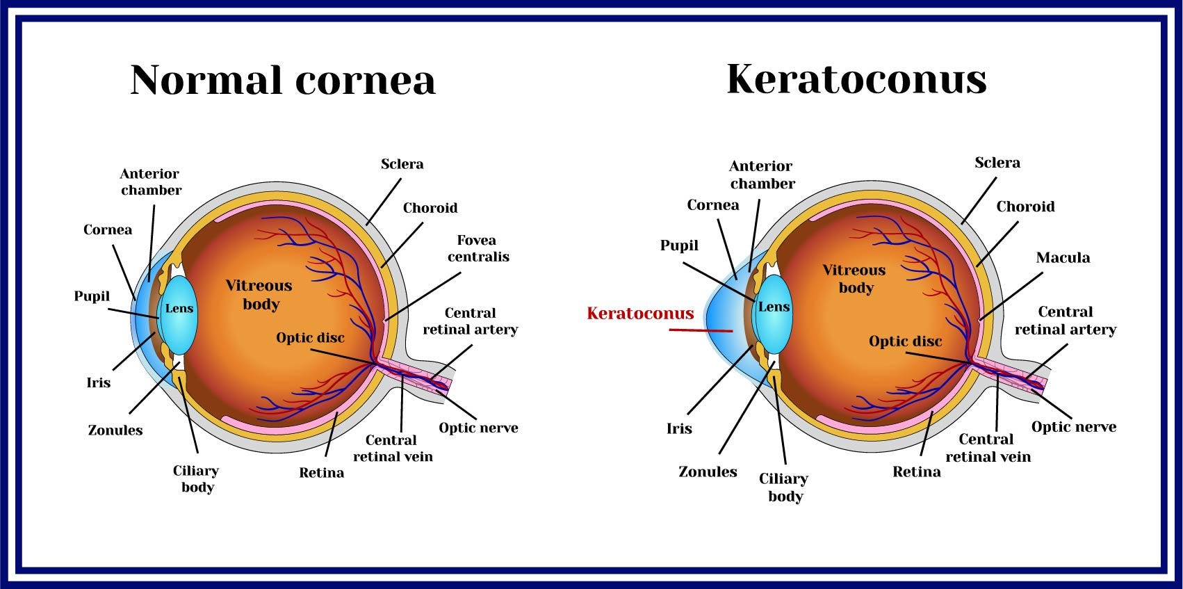 a keratoconus myopia)