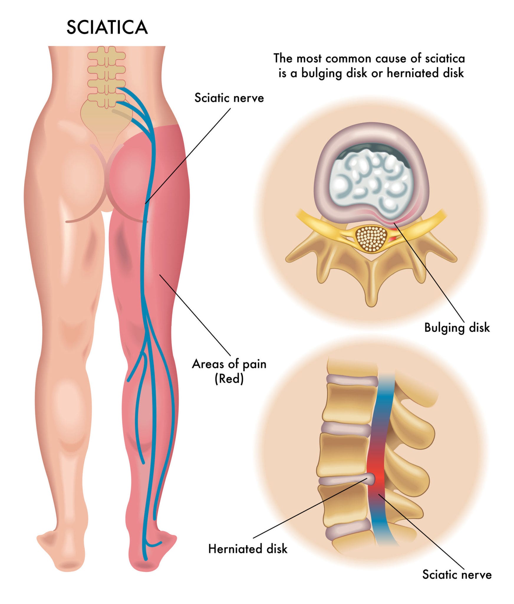 Natural Treatment for Sciatica Nerve Pain - Victor Tsan - Medium Natural Treatment for Sciatica Nerve Pain - Victor Tsan - Medium