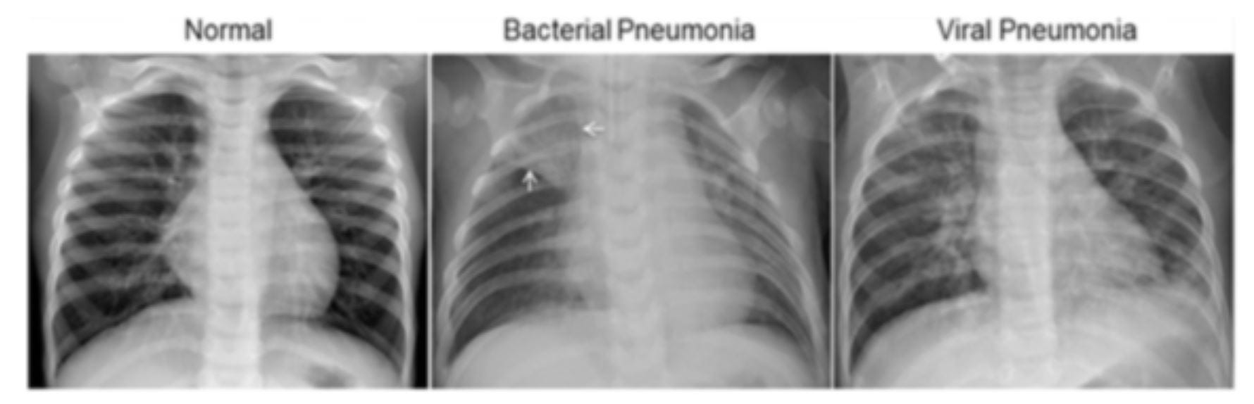 Deep Learning in Healthcare — XRay Imaging (Part 3Analyzing images