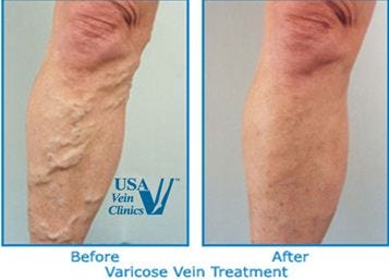 vein treatment cost internet