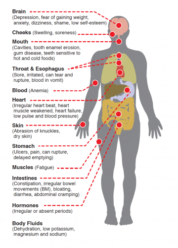 bulimia esophagus damage