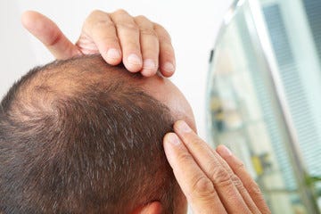 15 Proven Ways To Stop Hair Loss In Men Theskininn Medium