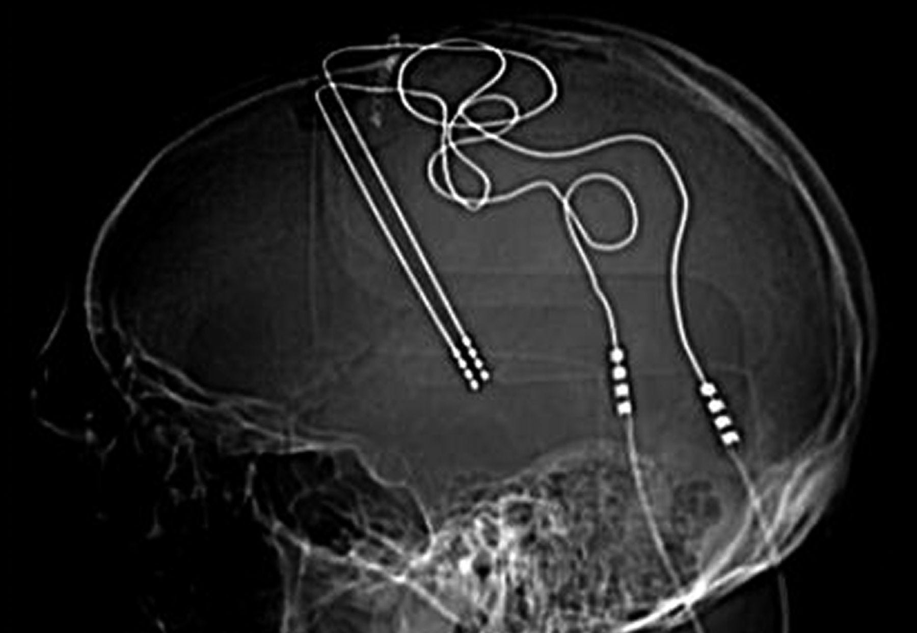 Can deep brain stimulation find success beyond Parkinson's disease? | by  Proceedings of the National Academy of Sciences | Proceedings of the  National Academy of Sciences | Medium