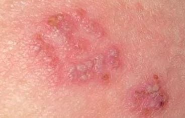 Cara Mengobati Penyakit Herpes Agar Sembuh Total Obat