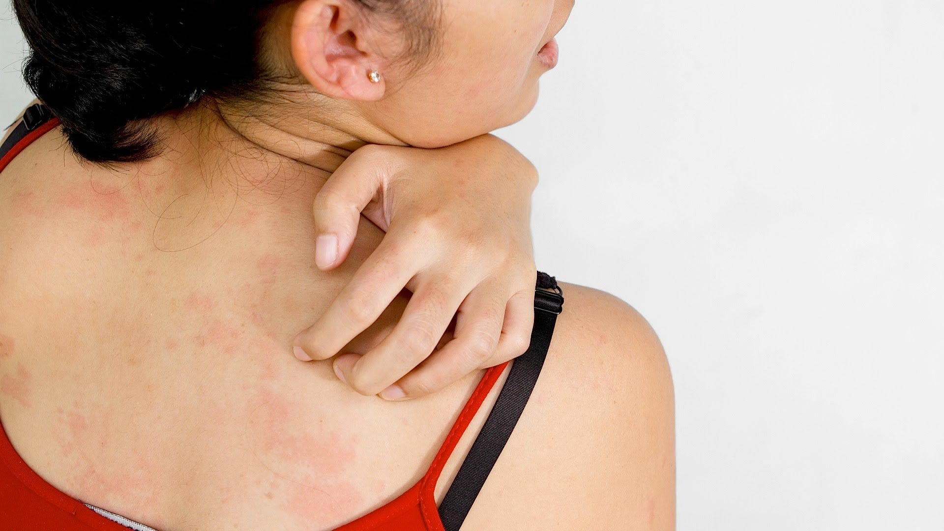 home remedies for itchy skin