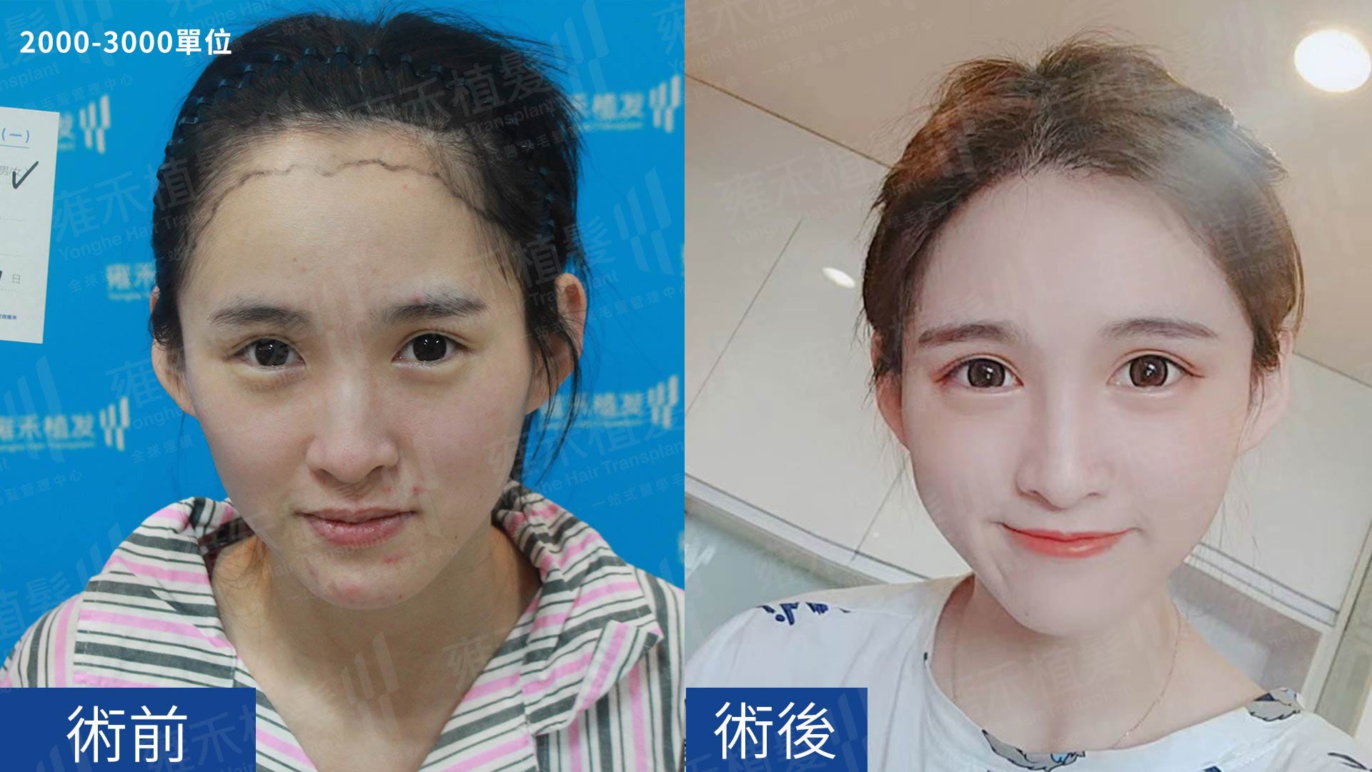 女士髮際線植髮費用是多少 女士髮際線植髮費用是多少 是很多女性朋友們比較關心的問題 因為生活中各種因素導致 By Wenzi Medium