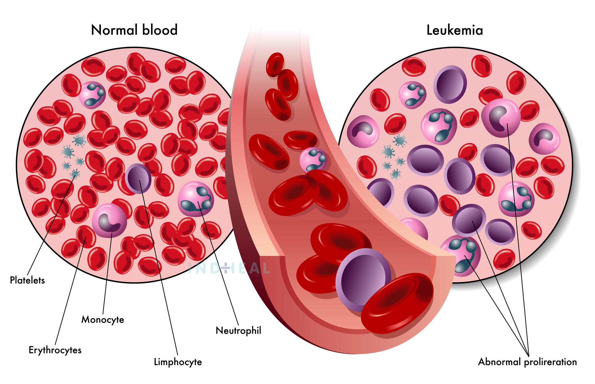 Different types of Blood cancer and it’s treatment INDHEALBest