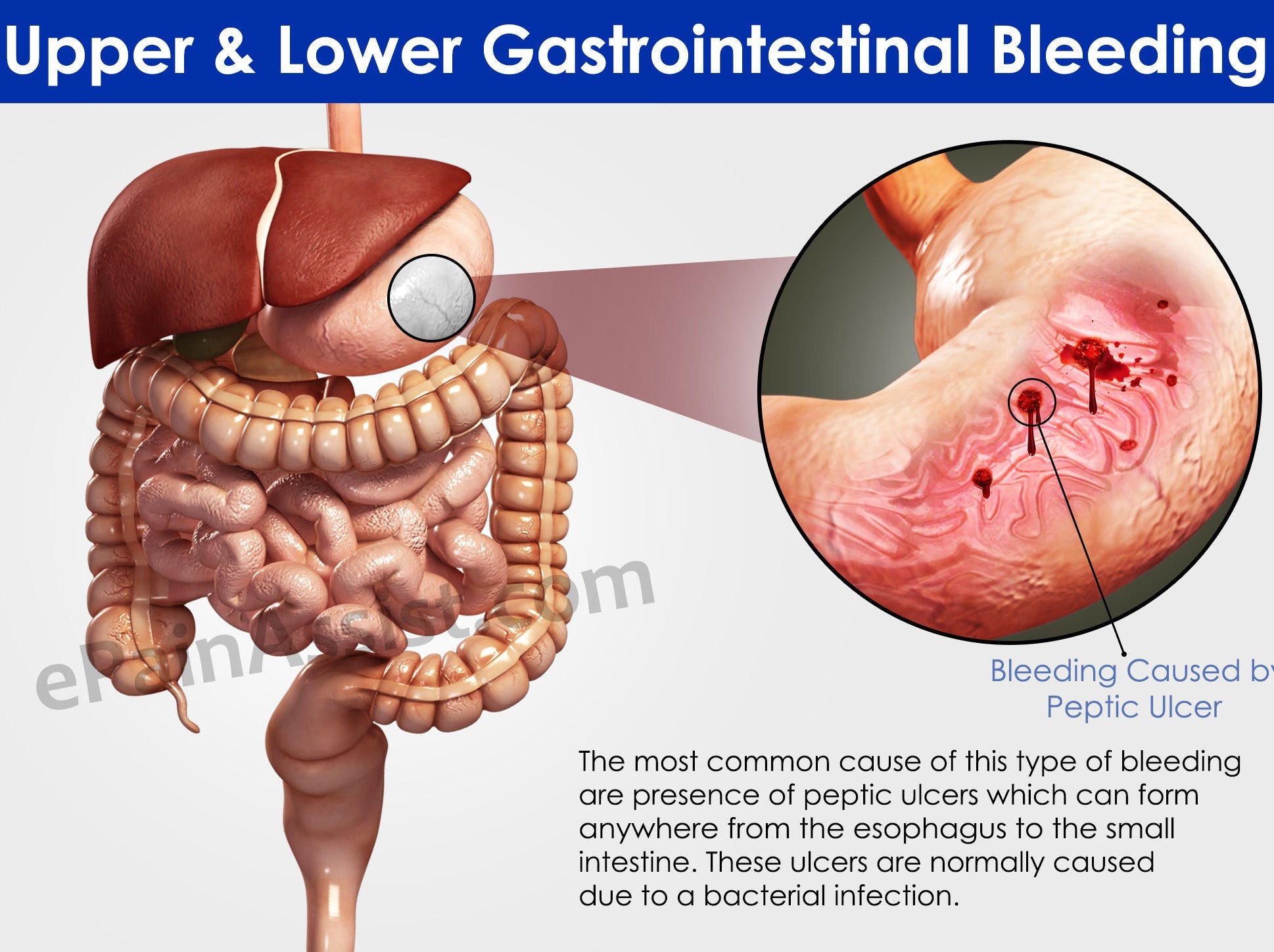 Gastrointestinal Bleeding 7537