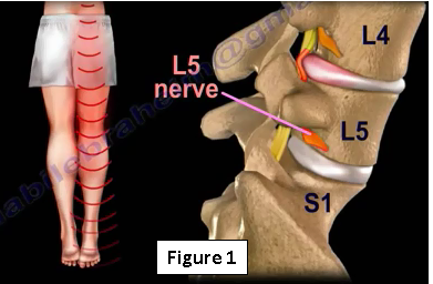 Piriformis Syndrome Or True Sciatica Are They The Same Or Different By Nabil Ebraheim Thrive Global Medium Piriformis Syndrome Or True Sciatica Are They The Same Or Different By Nabil Ebraheim Thrive Global Medium