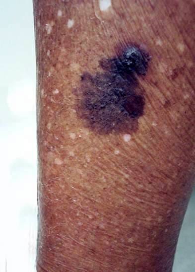 Blacks Get Skin Cancer Too. I know you've heard the myths: | by Raechele  Cochran Gathers, MD | Medium