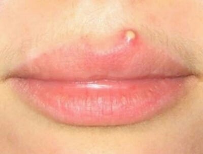 8 Ways On How To Treat Zit On Lip Pimples By Nigerian Health Blog Medium