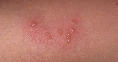 Cara Mengobati Herpes Saat Hamil Cipujac Medium
